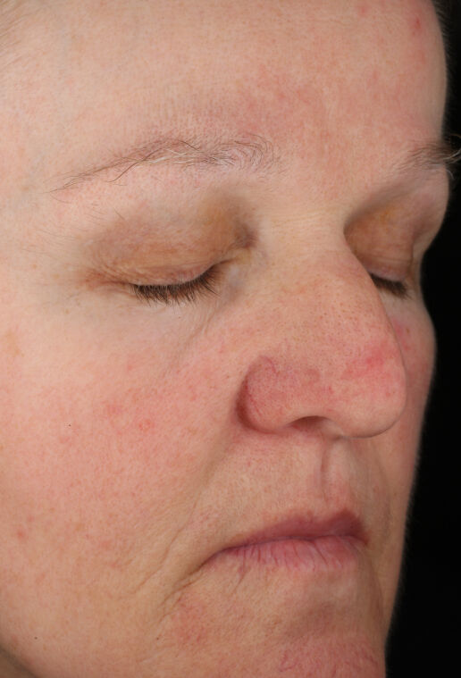 Rozatrol | Redness & Rosacea Serum | ZO Skin Health, Inc.